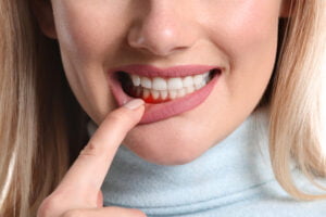 Women pulling her lower lip down to show red gums