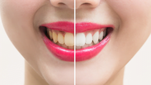 Before and after picture of yellow teeth being whitened