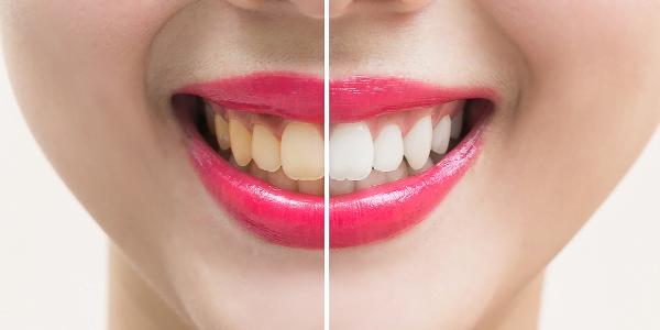 Before and after picture of yellow teeth being whitened