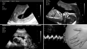 Pregnancy scans