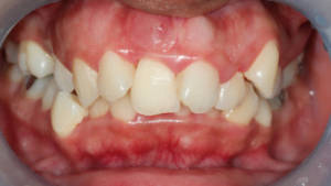 closeup view of someone's mouth, gums and teeth