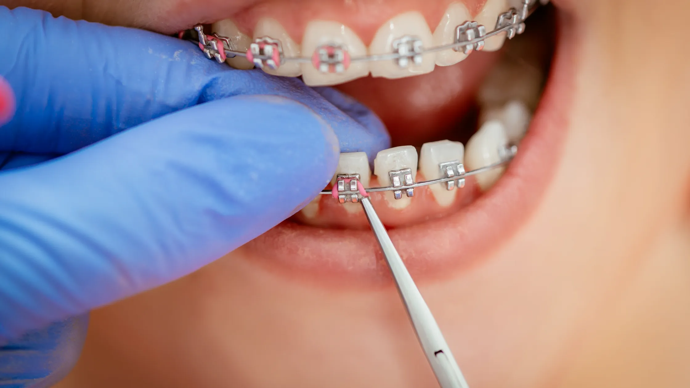 https://decare.ie/wp-content/uploads/2024/03/Braces.webp