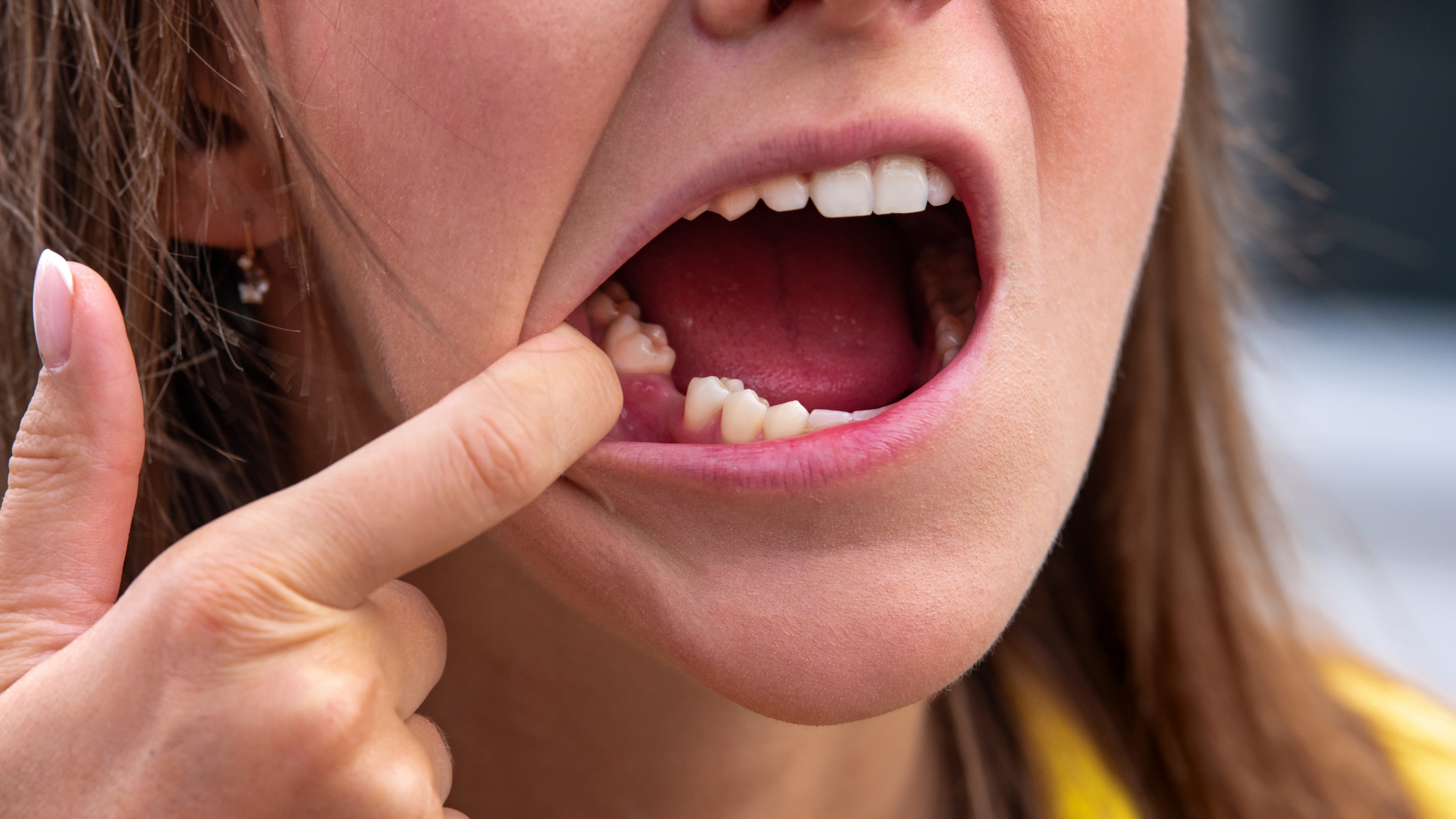 Aftercare For A Tooth Extraction | Blog | DeCare