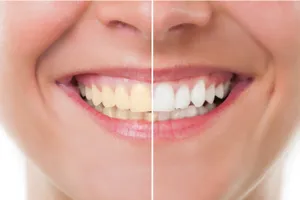 https://decare.ie/wp-content/uploads/2024/03/Tooth-Whitening-CP.webp