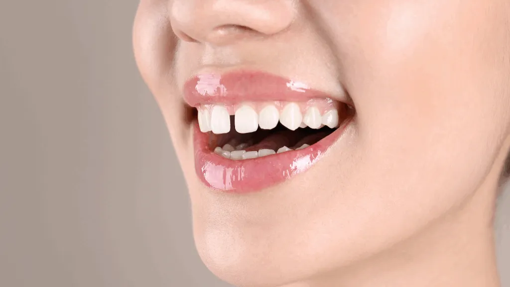 https://decare.ie/wp-content/uploads/2025/05/Diastema-640x300-c-default.webp