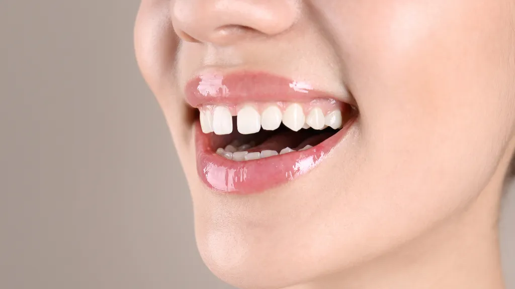 https://decare.ie/wp-content/uploads/2025/05/Diastema.webp
