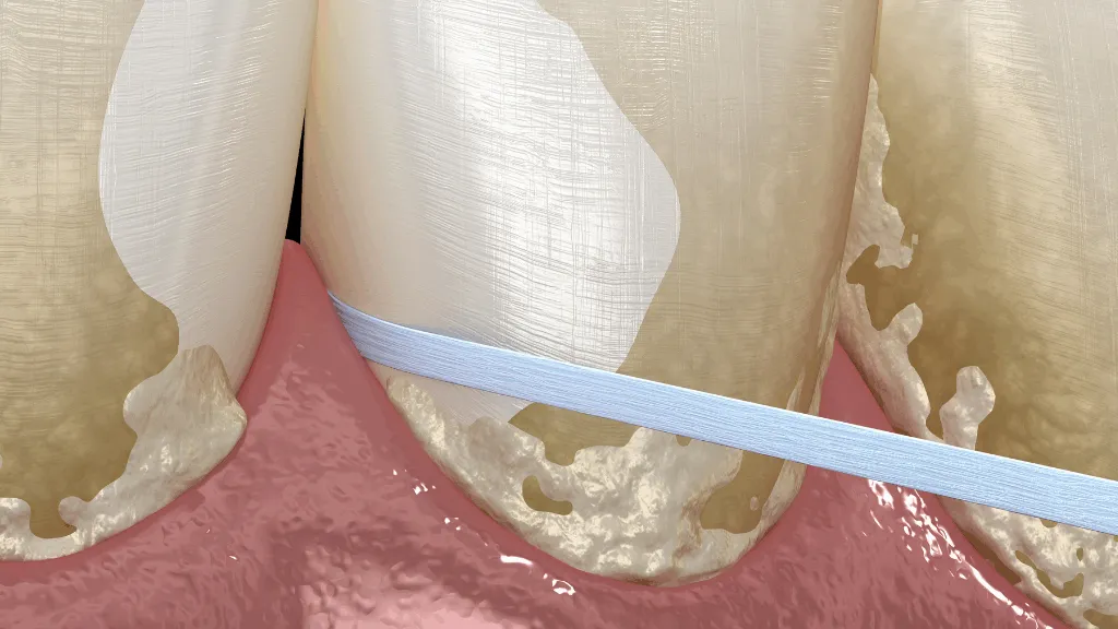https://decare.ie/wp-content/uploads/2025/06/Dental-Plaque-640x300-c-default.webp