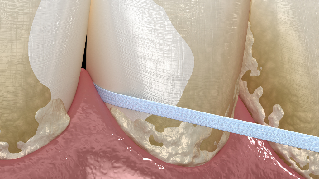 Dental Plaque Biofilm Decare