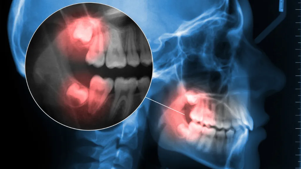 https://decare.ie/wp-content/uploads/2025/08/Wisdom-Teeth.webp