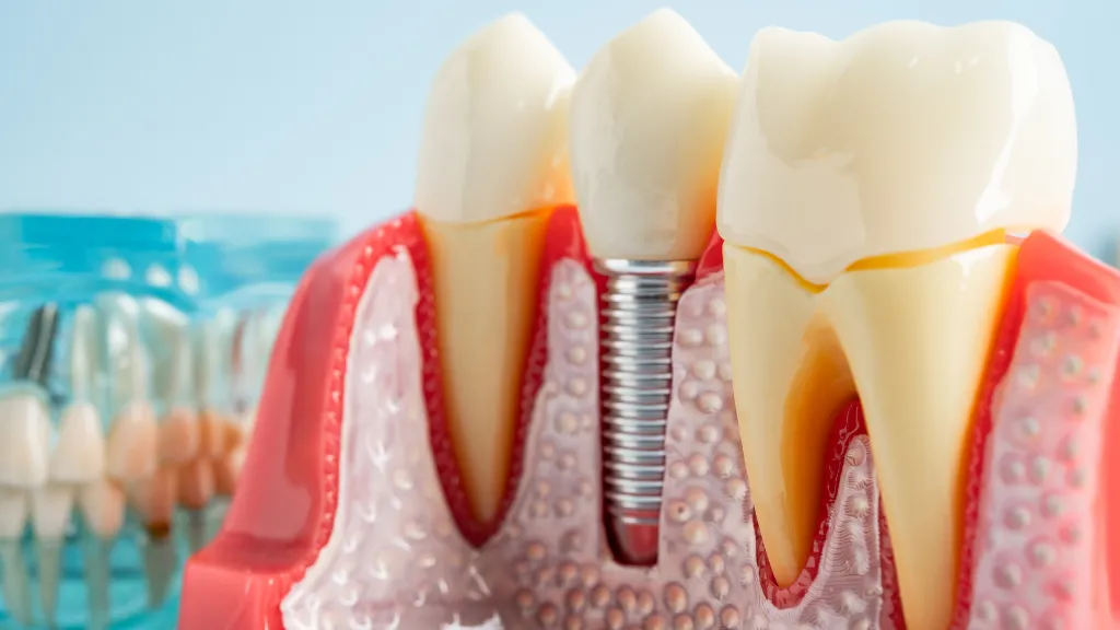When do i know if i need a root canal?